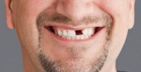 К чему снится сломанный зуб?